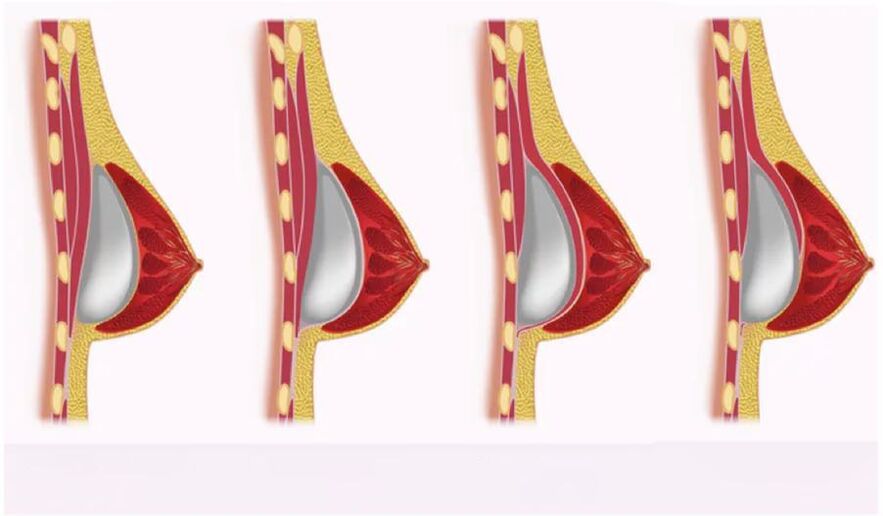 approach for implant placement